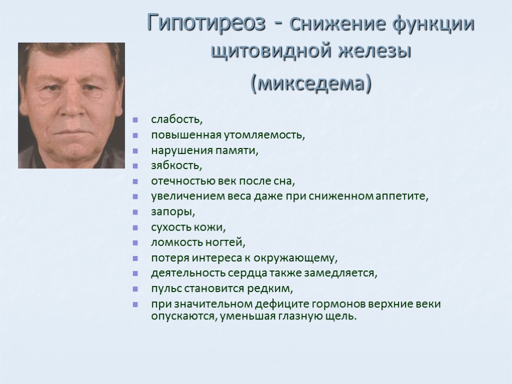 Гипотиреоз - снижение функции щитовидной железы (микседема) слабость, повышенная утомляемость, нарушения памяти, зябкость, отечностью